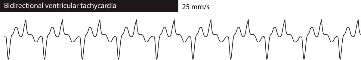 Figure 3. Tachycardie ventriculaire bidirectionnelle.