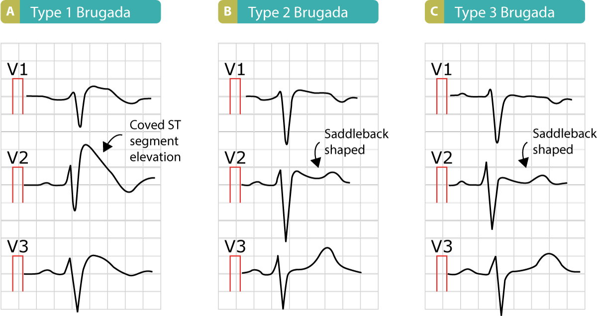 Figure 10. Les trois aspects ECG du syndrome de Brugada et les sus-décalages caractéristiques du segment ST.