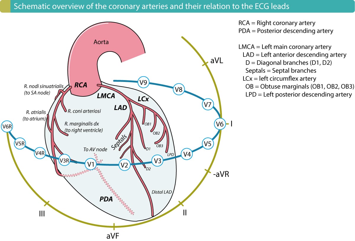 Le ventricule droit est vascularisé par l'artère marginale droite (r. marginalis dx), qui naît de l'artère coronaire droite (ACD). L'ACD vascularise également la paroi inférieure du ventricule gauche chez plus de 90 % des individus. Par conséquent, une occlusion proximale (de l'ACD) qui interrompt le flux sanguin vers le ventricule droit affectera également la paroi inférieure du ventricule gauche dans 90 % des cas.