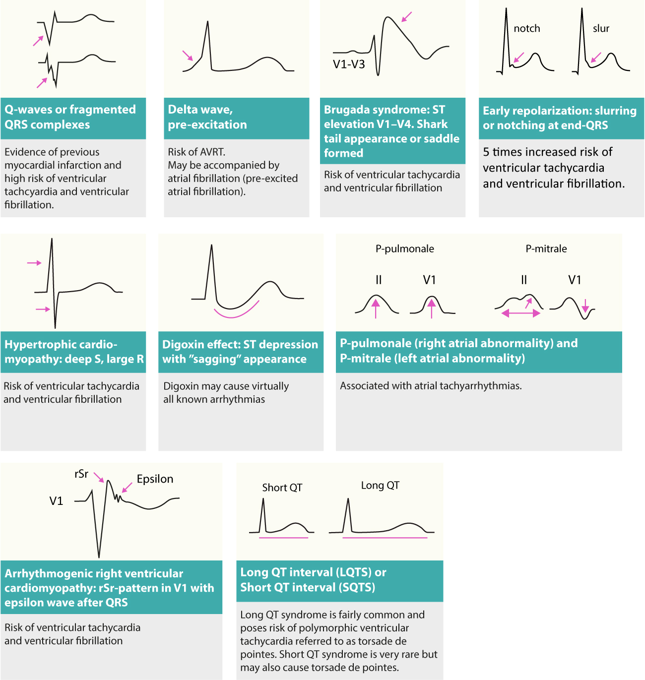 Figure 3 : Modifications de l’ECG au repos pouvant révéler la cause des arythmies (substrats de l’arythmie).