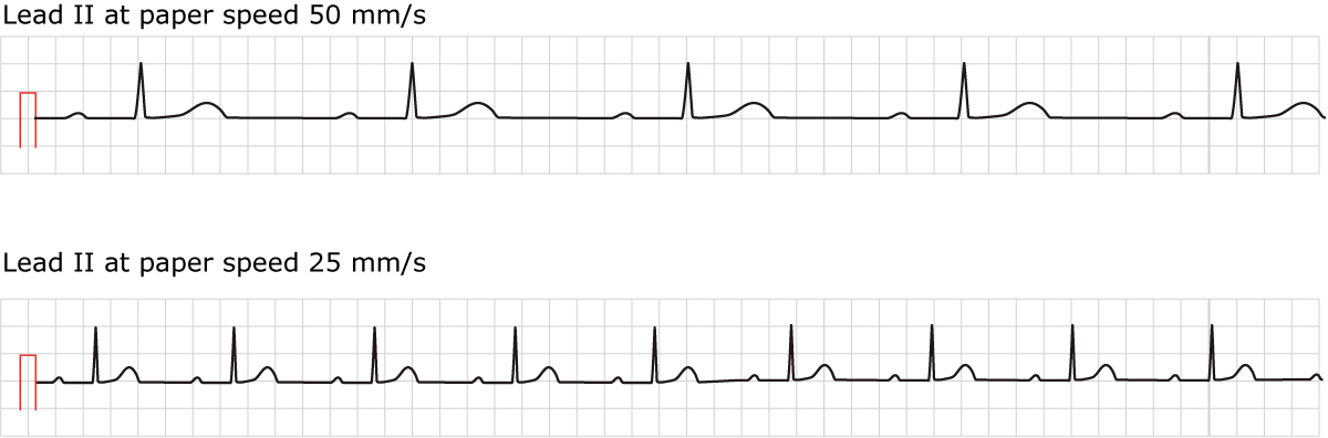 ECG de bloc auriculo-ventriculaire du premier degré avec intervalle PR allongé