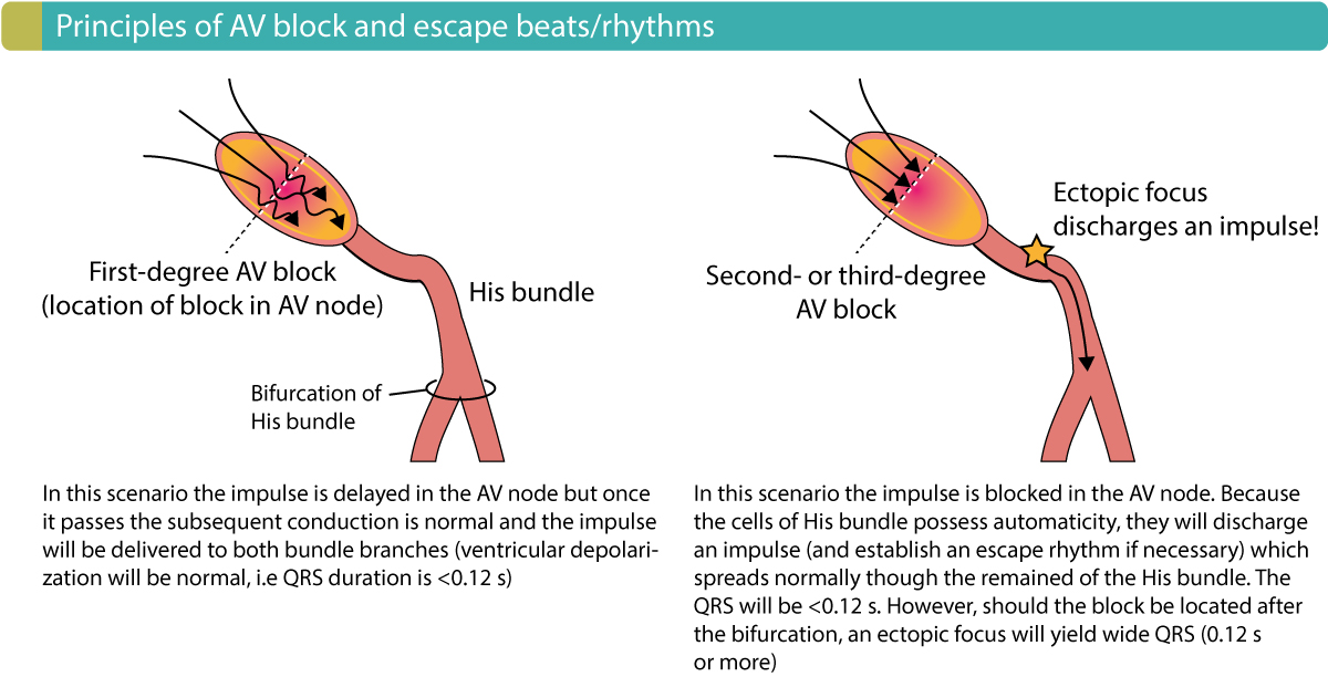 Figure 2. Principes des blocs AV et de l’émergence des rythmes/battements d’échappement.