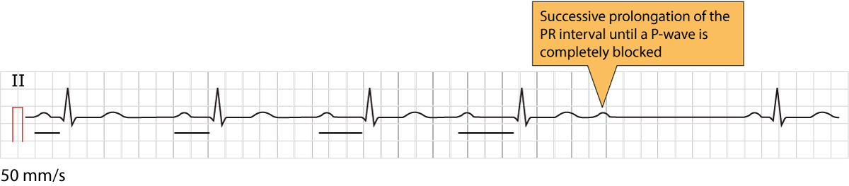 Figure 1. Bloc AV du second degré de Mobitz type 1, également connu sous le nom de bloc de Wenckebach. Notez l'allongement progressif de l'intervalle PR avant l'onde P bloquée.