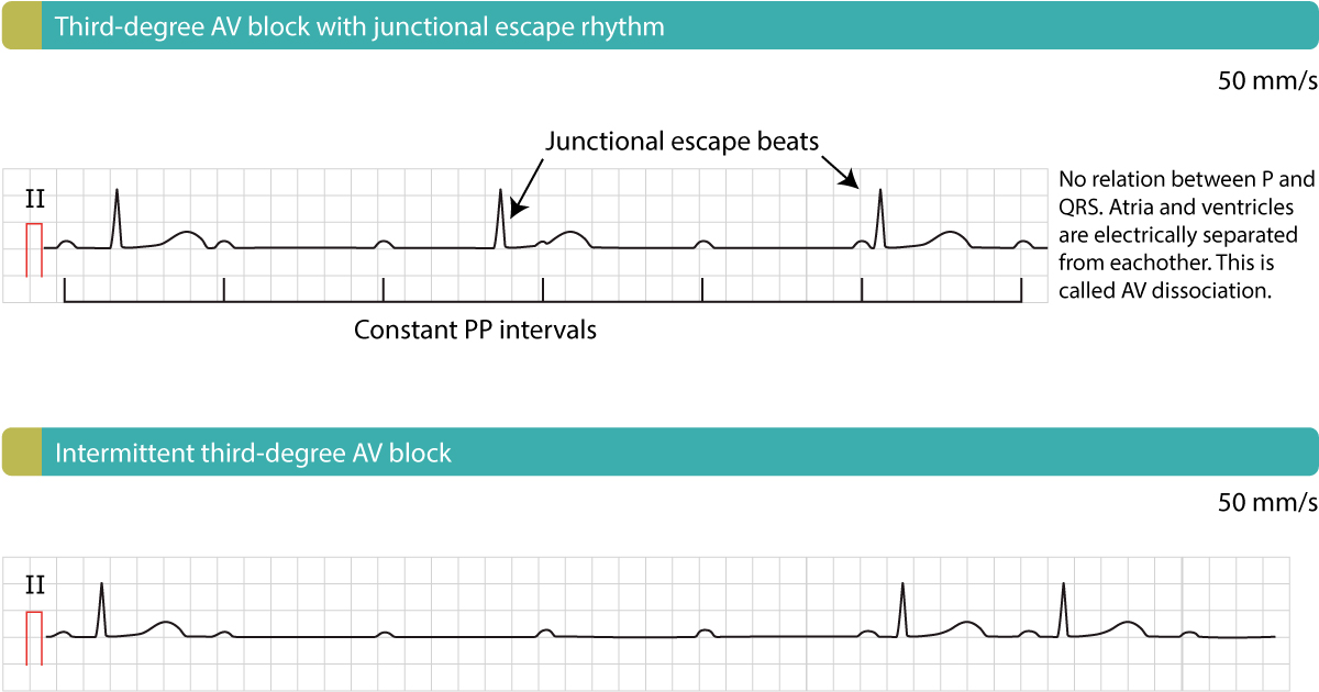 Figure 1. Bloc AV du troisième degré (bloc cardiaque complet, dissociation AV). Notez la dissociation complète entre les ondes P régulières et les QRS lents.