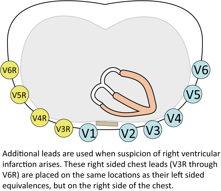 Figure 3. Dérivations précordiales droites dans l’infarctus du ventricule droit.