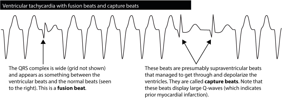 Figure 6. Battements de capture et battements de fusion observés au cours d'une tachycardie ventriculaire.