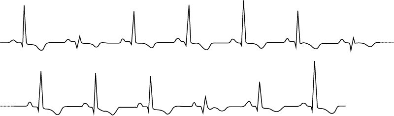 Figure 1. Alternances électriques chez un patient souffrant de tamponnade cardiaque. L’ECG montre des amplitudes variables du QRS et de l’onde T.