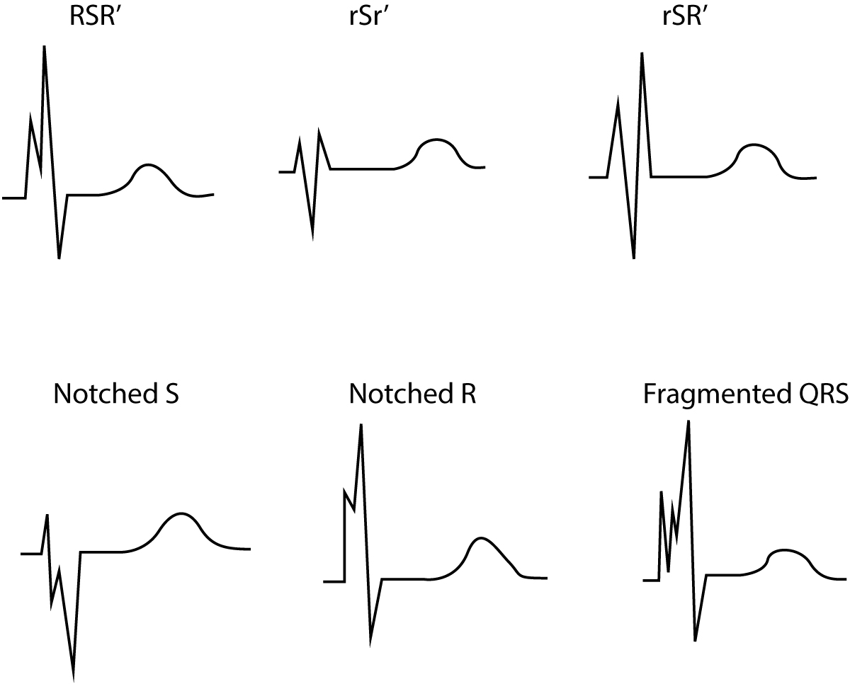 Figure 2. Complexe QRS fragmenté. Ces configurations du QRS évoquent également un infarctus du myocarde ancien.