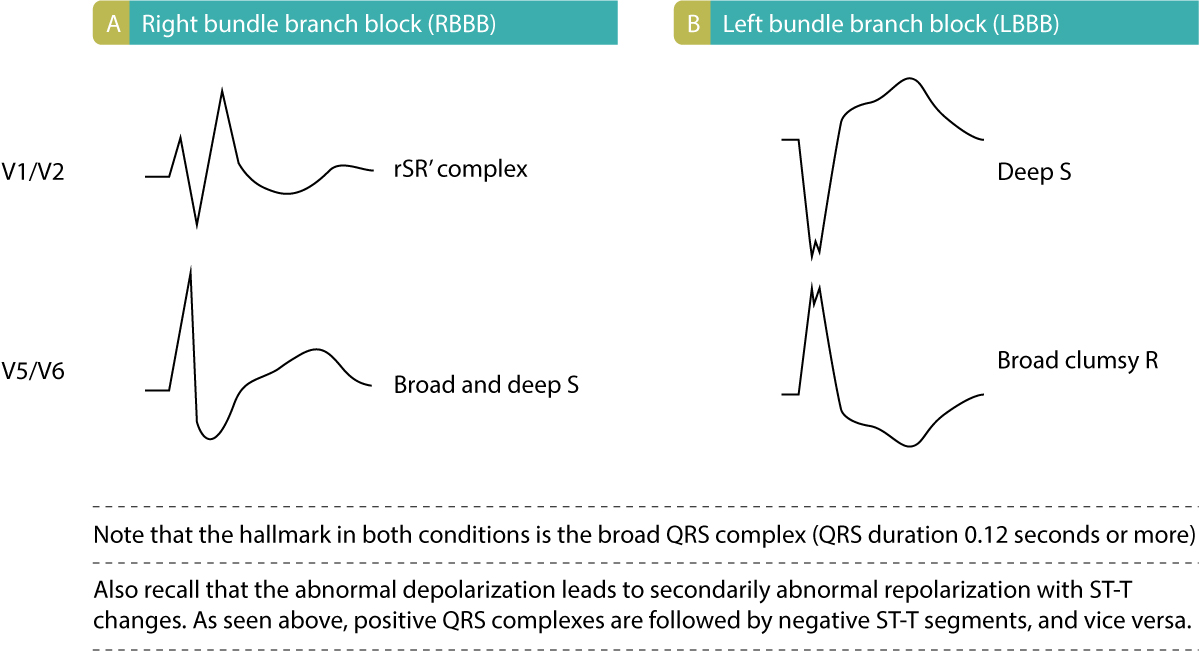 Figure 2. Caractéristiques des blocs de branche. (A) : Caractéristiques ECG du bloc de branche droit (BBD). (B) : Caractéristiques ECG du bloc de branche gauche (BBG).