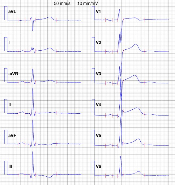 Figure 4. Onde d’Osborn (onde J) chez une patiente présentant une repolarisation précoce. Cette patiente était âgée de 31 ans lorsqu’elle est décédée d’une mort cardiaque subite.