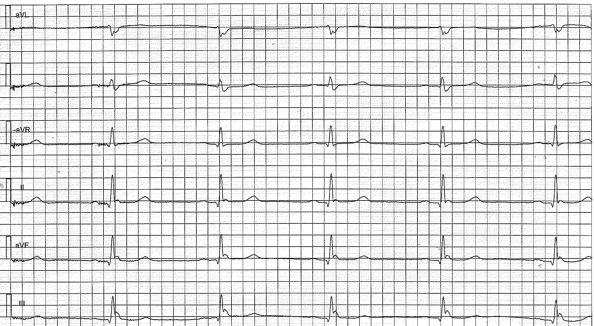 Figure 3. Ondes d’Osborn (ondes J) chez un patient présentant une repolarisation précoce.