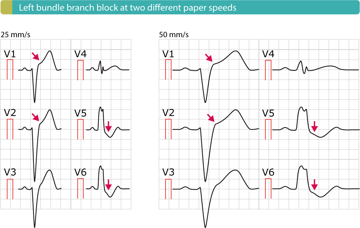 Figure 4. Bloc de branche gauche (BBG) avec élévations typiques du segment ST (V1–V2) et dépressions du segment ST (V5-V6).