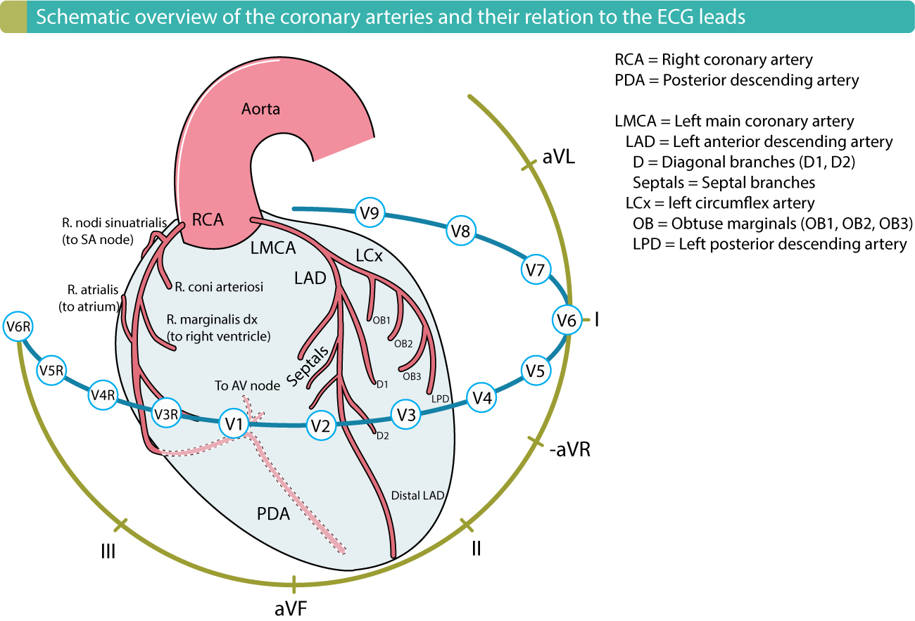 Figure 1. Les artères coronaires et leur relation avec les dérivations ECG. La localisation de l'infarctus du myocarde ou de l'ischémie se fait en utilisant les modifications de l'ECG pour déterminer la zone affectée et, par la suite, l'artère coronaire occluse (coupable).