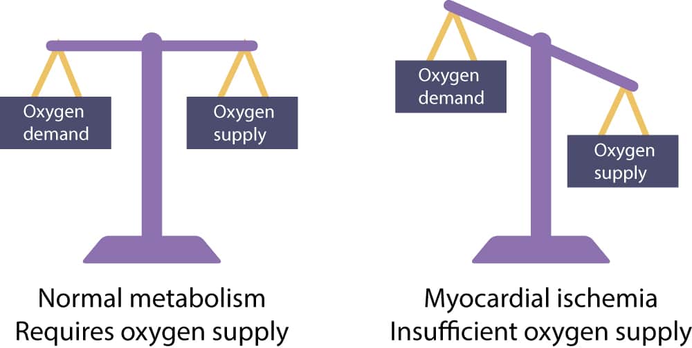 Figure 1. Les cellules myocardiques ont besoin d’un apport continu en oxygène pour maintenir un métabolisme normal. Si l’apport en oxygène est inférieur à la demande en oxygène, une ischémie se développe. Les cellules myocardiques peuvent basculer vers un métabolisme anaérobie et interrompre leurs contractions afin d’atténuer l’ischémie. Cela permet à la cellule de supporter jusqu’à 30 minutes d’ischémie sévère. Si le flux sanguin n’est pas rétabli avant 30 minutes, la cellule meurt. La mort des cellules myocardiques est appelée infarctus du myocarde.