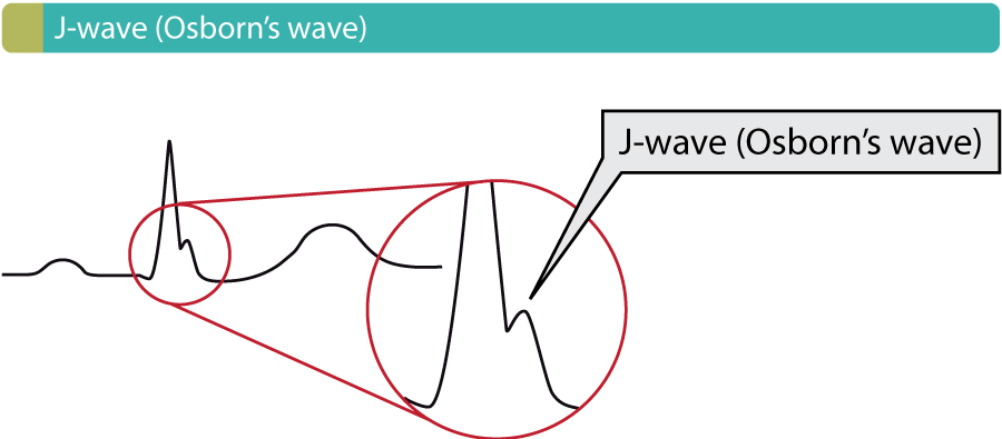 Figure 1. Onde d’Osborn (onde J). Ces ondes se produisent en raison de l’hypothermie, de l’hypercalcémie, de la repolarisation précoce et du syndrome de Brugada.