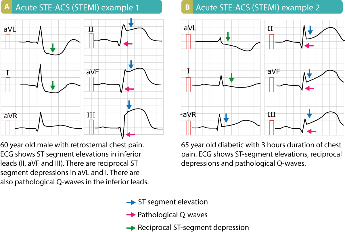 Deux ECG de STEMI montrant des ondes Q pathologiques
