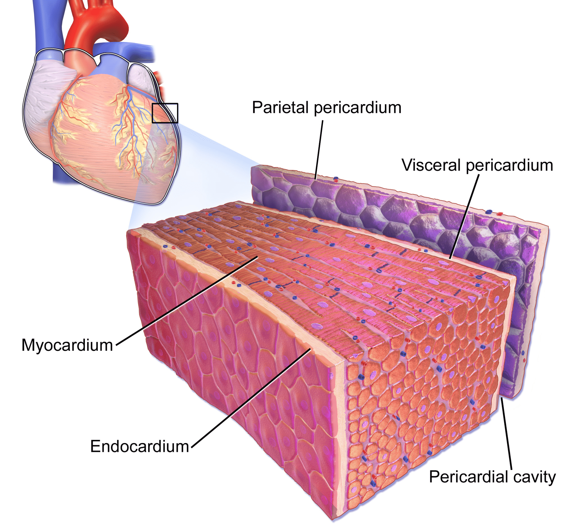 Figure 1. Le sac péricardique et le myocarde. Notez que la péricardite (inflammation du sac péricardique) est difficile à distinguer de la myocardite (inflammation du tissu myocardique) et, comme elles ont tendance à s’accompagner l’une l’autre, le terme de périmyocardite est souvent utilisé. Image de Bruce Blausen, Galerie Blausen 2014.