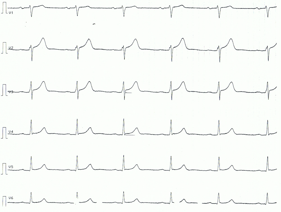 Dérivations thoraciques d'une péricardite aiguë avec sus-décalage du segment ST concave