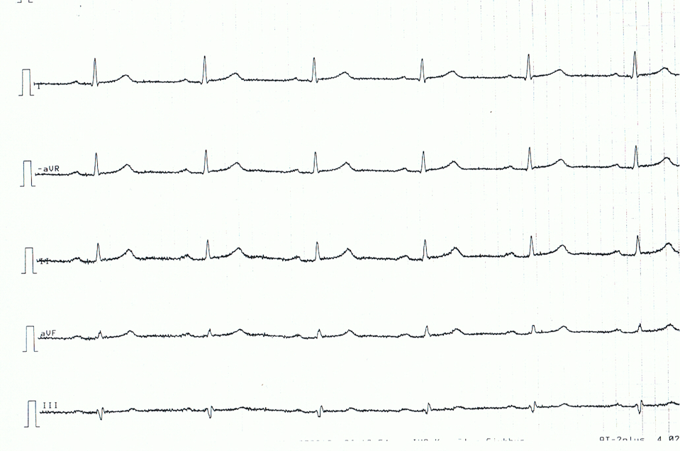Figure 4. Dérivations des membres d’un patient atteint de péricardite aiguë. Notez les élévations très discrètes, mais généralisées, du segment ST, les segments ST concaves.