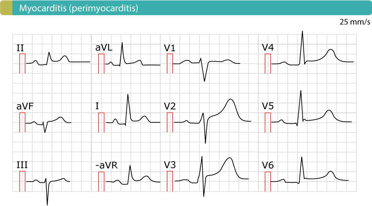 Figure 2. L’ECG dans une péricardite aiguë (myocardite, périmyocardite). Comme on peut le constater, il y a des élévations généralisées du segment ST. Il n’y a pas de dépressions réciproques du segment ST ni d’inversions simultanées de l’onde T (ondes T négatives).