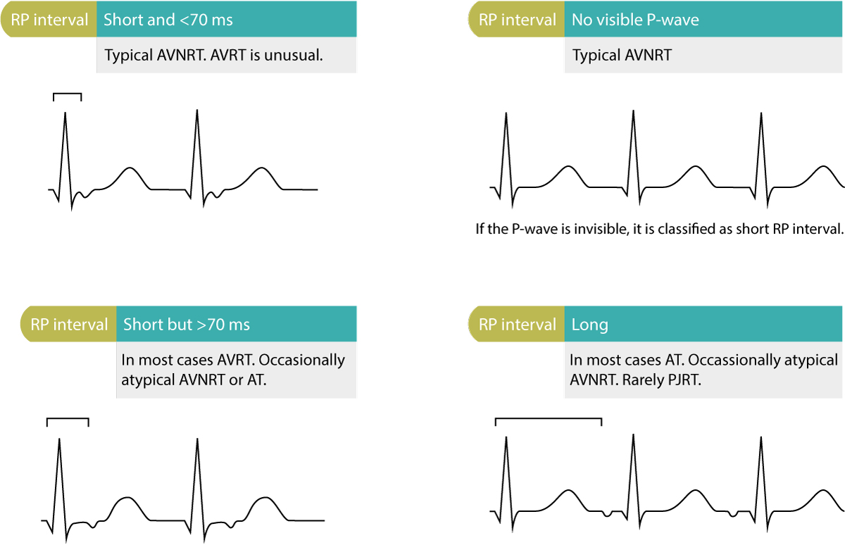 Figure 2 : Diagnostics différentiels basés sur l’intervalle RP.