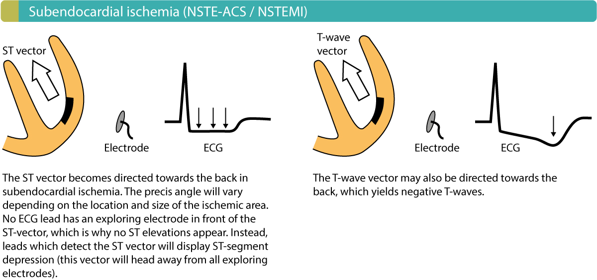 Figure 4. Courants de lésion dans l’ischémie sous-endocardique. Ils sont caractéristiques de l’infarctus du myocarde sans sus-décalage du segment ST (NSTEMI/Non-STEMI).