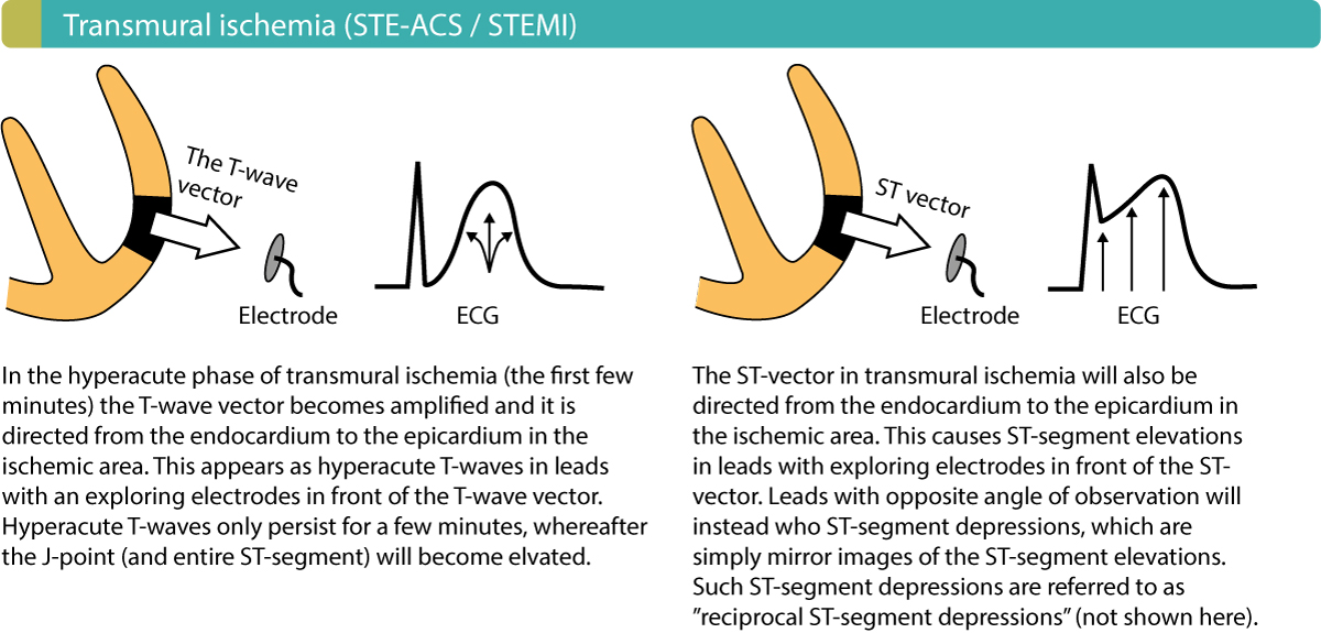 Figure 3. Courants de lésion dans l’ischémie myocardique transmurale. Notez que l’infarctus du myocarde avec sus-décalage du segment ST (STEMI/STE-ACS) provoque généralement aussi des sous-décalages du segment ST dans les dérivations opposées à celles qui présentent les sus-décalages du segment ST. Cependant, la principale modification de l’ECG dans le STEMI/STE-ACS est le sus-décalage du segment ST.