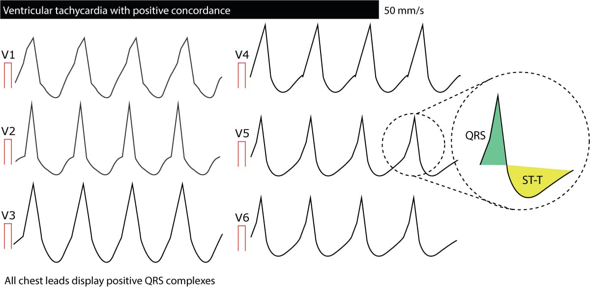 Figure 7. Concordance des complexes QRS de V1 à V6 au cours d'une tachycardie ventriculaire.