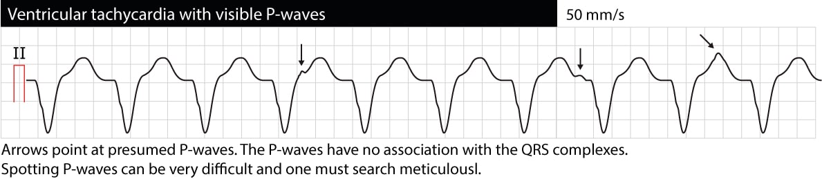 Figure 1. Tachycardie ventriculaire monomorphe (TV). Les ondes P sont visibles mais n'ont aucune relation avec les complexes QRS. Cette situation est appelée « dissociation AV » et indique que les activités auriculaire et ventriculaire sont indépendantes. La dissociation AV confirme que l'arythmie est une tachycardie ventriculaire. Cependant, la dissociation AV est souvent difficile à repérer.
