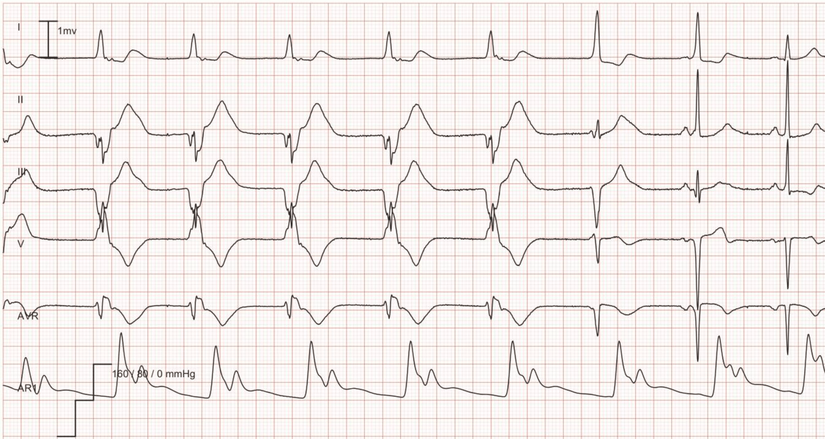 Exemple d’ECG : Rythme idioventriculaire (rythme ventriculaire accéléré). Rythme ventriculaire accéléré à une fréquence de 56 pendant les 5 premiers battements, suivi de 2 battements de fusion ; les 2 derniers battements sont un rythme sinusal normal.