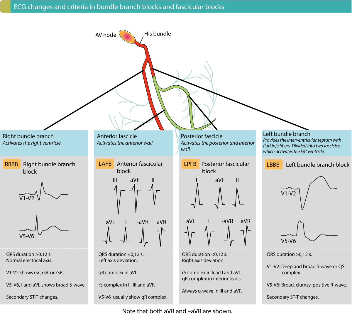 Figure 3. Aperçu des critères et des modifications de l’ECG dans les blocs de branche et les blocs fasciculaires. Tous ces retards de conduction intraventriculaire sont courants et il est donc important de les reconnaître.