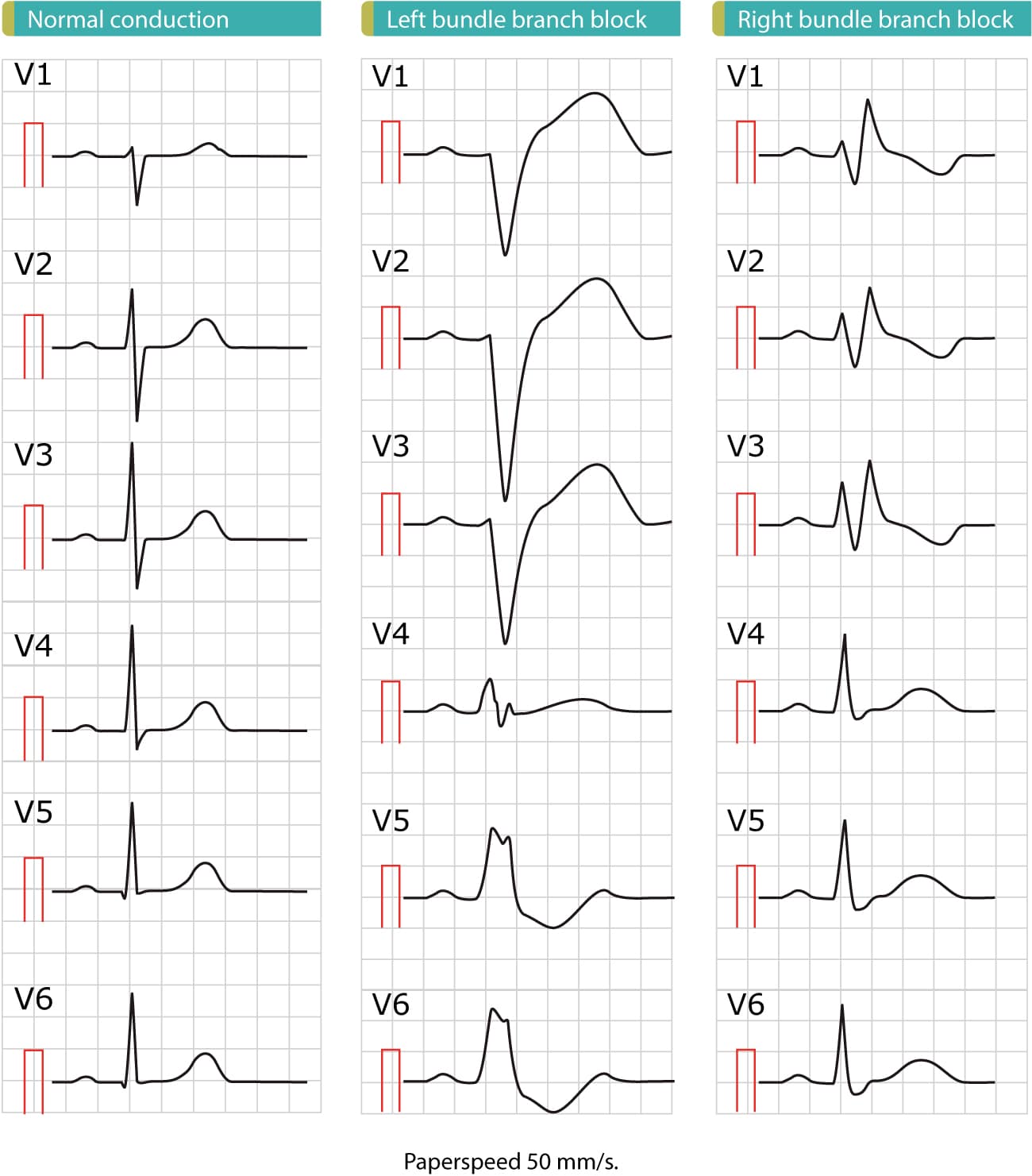 ECG de bloc de branche gauche avec onde R large et encochée en V6 et complexe QS en V1