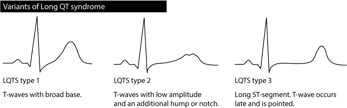 Figure 3. Caractéristiques des ondes T dans les différents types de SQTL (syndrome du QT long).