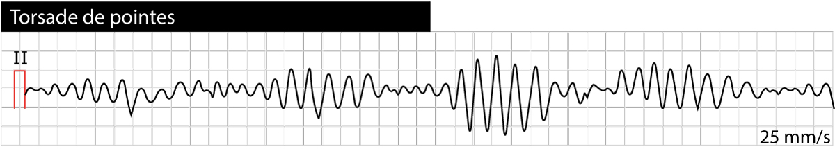 Figure 2 : Torsade de pointes (tachycardie ventriculaire polymorphe) causée par un syndrome du QT long.