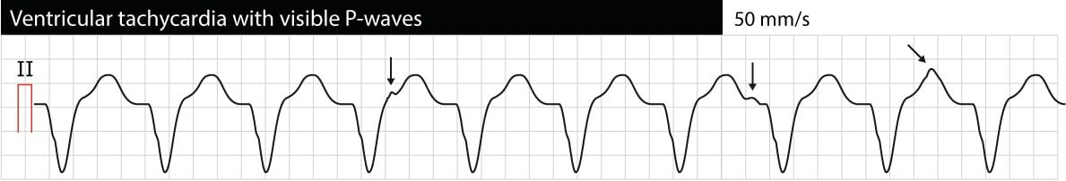 Figure 1. Tachycardie ventriculaire monomorphe (TV). Les ondes P sont visibles mais ne présentent aucun lien avec les complexes QRS. Cette situation est appelée dissociation atrioventriculaire.
