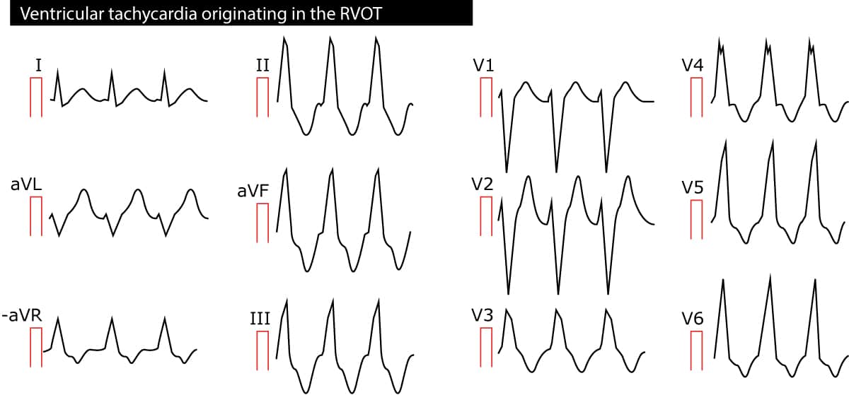 Figure 2. Tachycardie ventriculaire (TV) provenant de la voie de sortie du ventricule droit (RVOT).