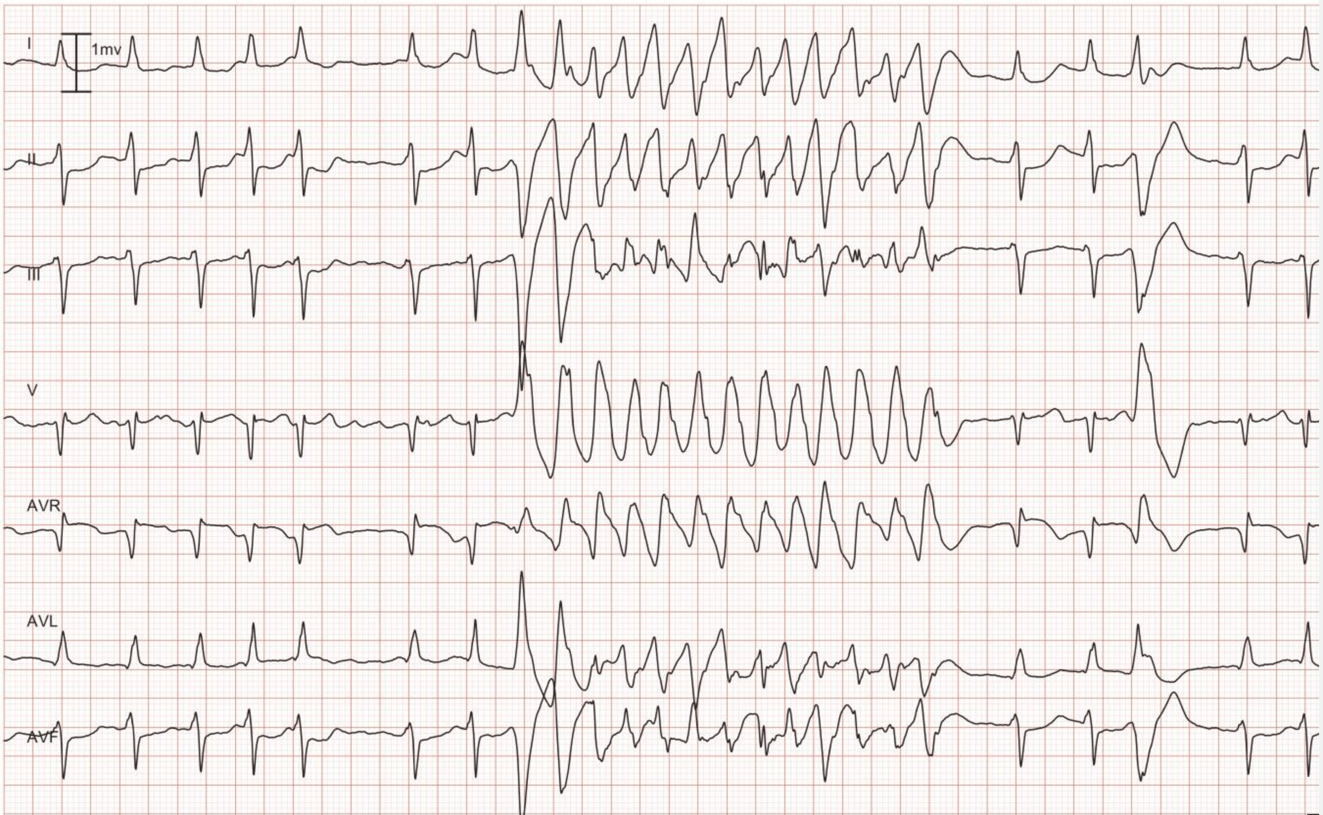 Figure 8. Dérivations I, II, III, V1, aVR, aVL et aVF. Comme on le voit au début de l’enregistrement, le patient présente un rythme sous-jacent de fibrillation auriculaire. La fibrillation auriculaire est interrompue par une tachycardie rapide et régulière avec un complexe QRS large. Le 4e battement à partir de la fin est un battement ventriculaire prématuré dont la morphologie du QRS est identique à celle du QRS observé pendant la tachycardie. Par conséquent, la tachycardie provient également des ventricules, ce qui implique qu’il s’agit d’une tachycardie ventriculaire (TV).