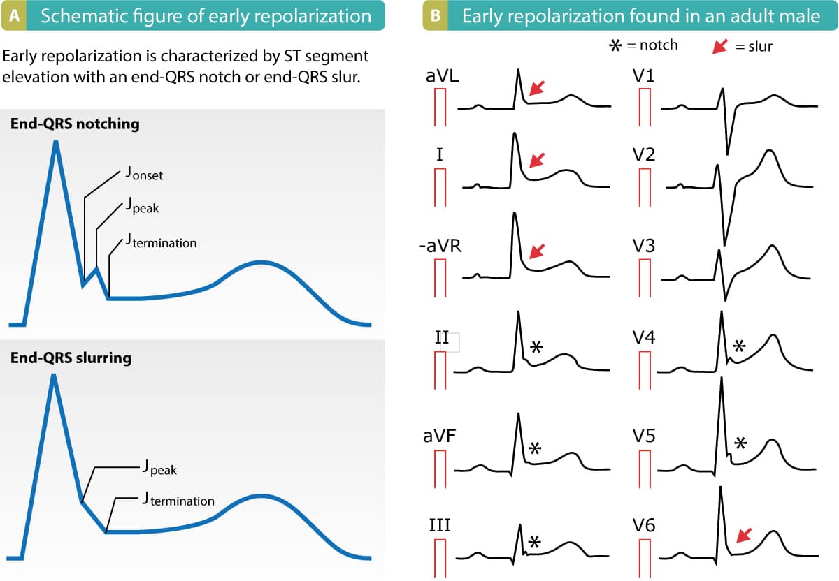 Figure 5. Repolarisation précoce (d'après MacFarlane et al, 2015, J Am Coll Cardiol)