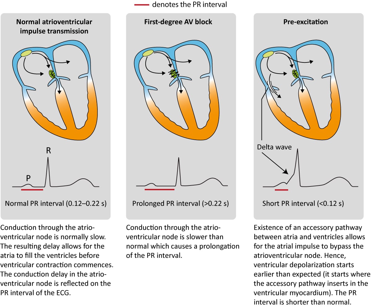 Figure 4. Transmission de l'impulsion des oreillettes aux ventricules. L'intervalle PR indique si la transmission de l'impulsion par le nœud AV est normale (premier panneau), anormalement lente (deuxième panneau) ou contournée (troisième panneau).