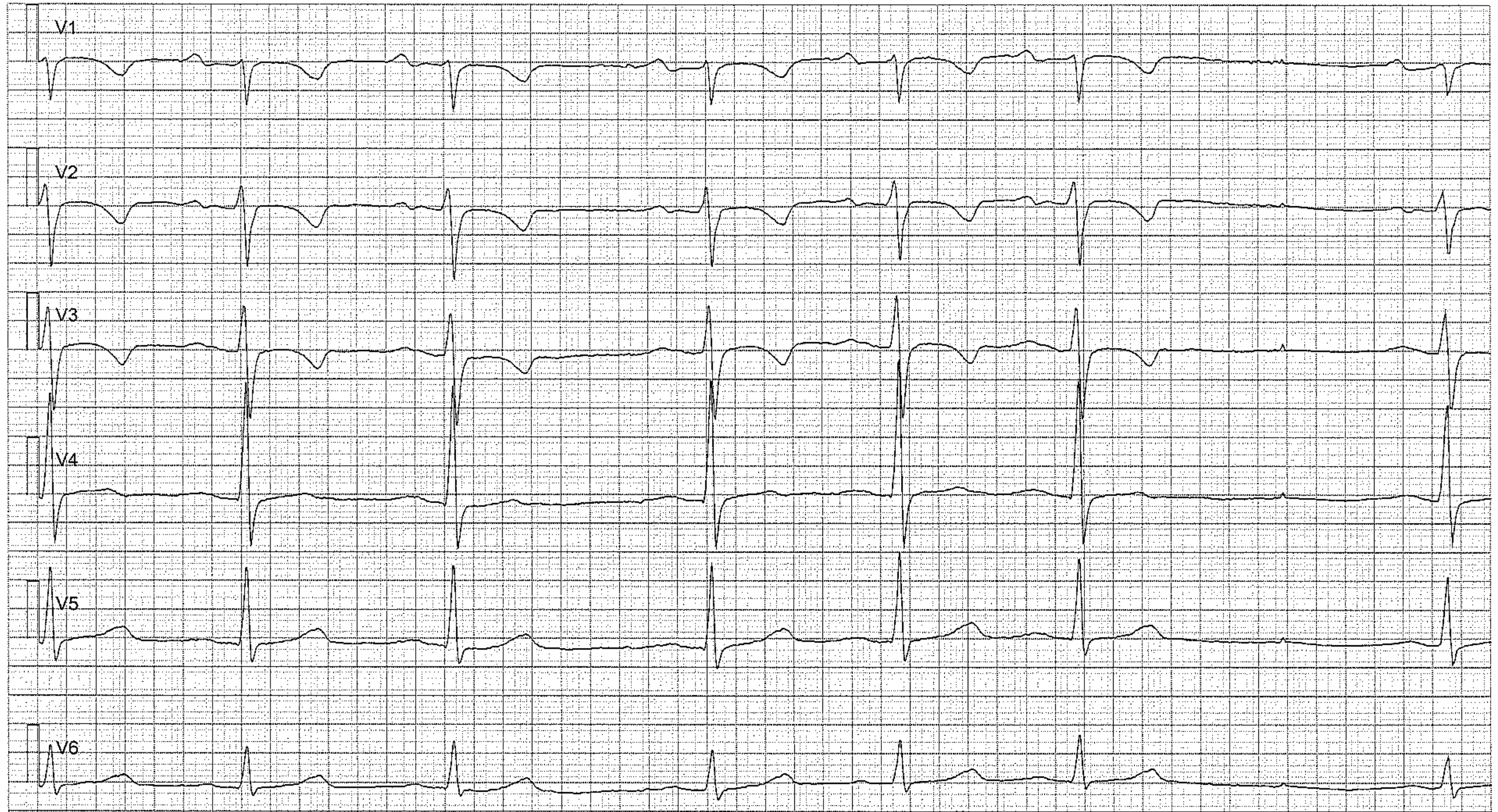 Figure 4 (patient âgé de 15 ans). Arythmie sinusale marquée avec pause sinusale. Les ondes T négatives en V1–V3 peuvent encore être physiologiques à cet âge (aspect juvénile persistant).