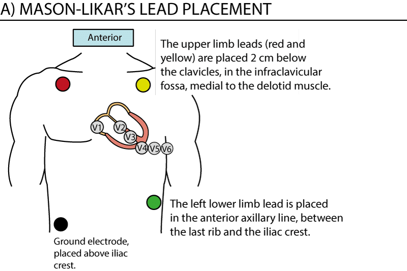 Figure 1. Placement des dérivations pour l'ECG d'effort. Notez que les dérivations précordiales (thoraciques) sont placées normalement. Les dérivations des membres sont déplacées vers le torse, ou en position proximale sur les membres. Le placement des dérivations représenté ici est appelé Mason-Likar