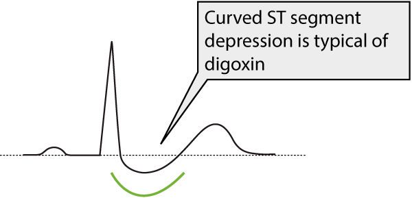 Figure 1. Dépression du segment ST (aspect en cupule) due au traitement par la digoxine.