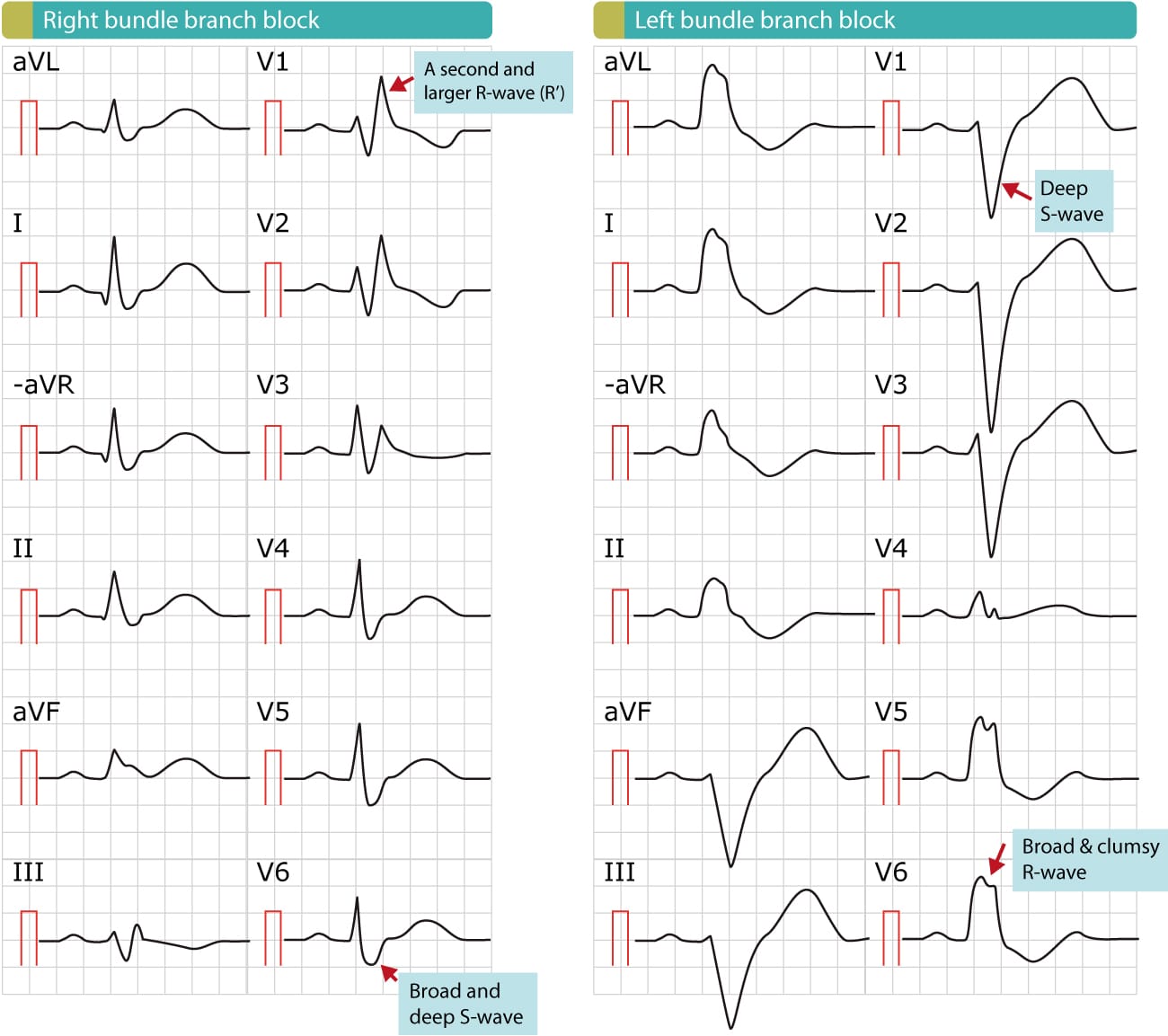 ECG de bloc de branche droit avec aspect rSR' en V1 et onde S empâtée en V6