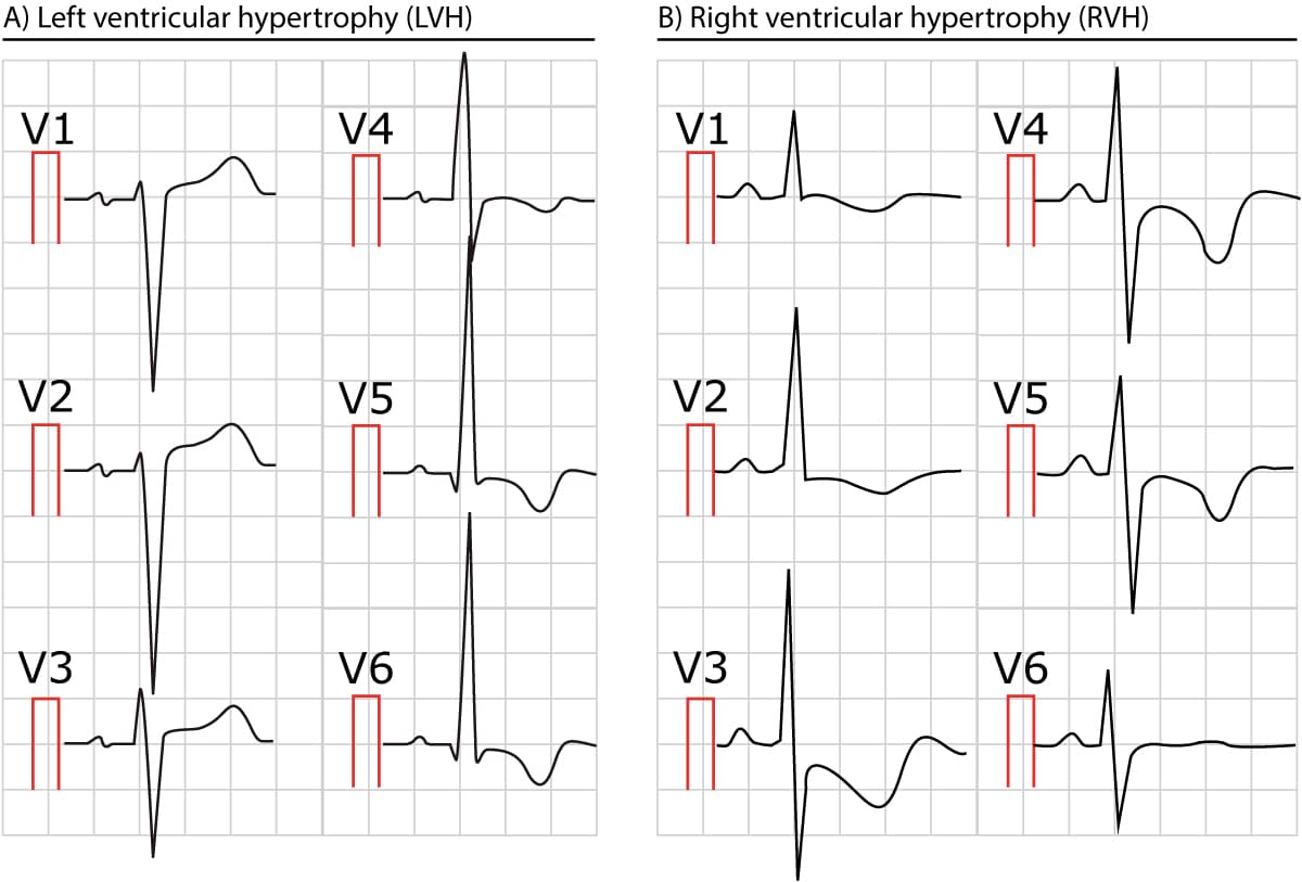 ECG d'hypertrophie ventriculaire gauche et d'hypertrophie ventriculaire droite avec grandes ondes R et ondes S profondes