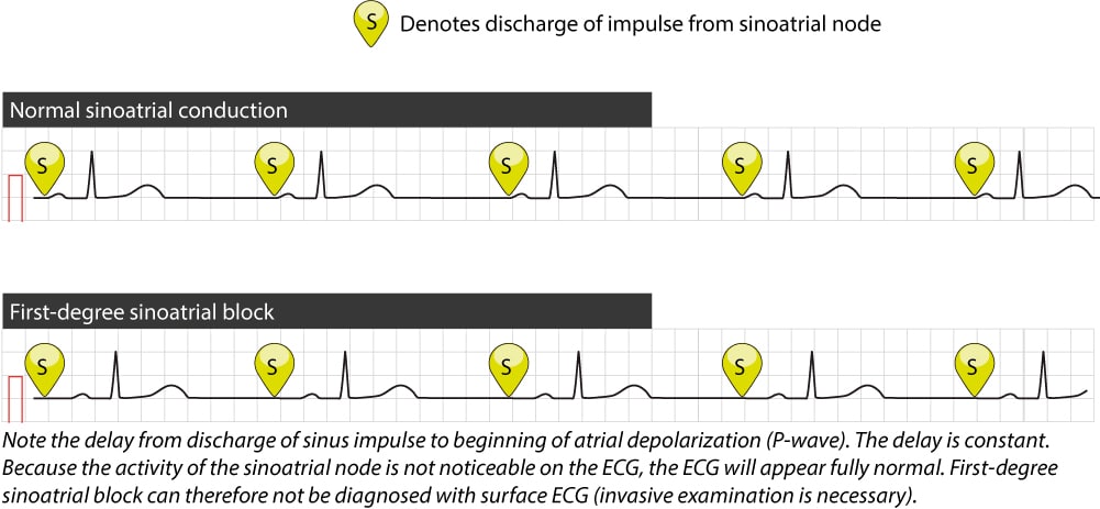 Figure 1. Le tracé supérieur montre une conduction normale de l’impulsion du nœud sinusal vers les oreillettes. L’activation auriculaire commence presque immédiatement après la décharge de l’impulsion dans le nœud sinusal. Le tracé du bas montre un bloc sino-auriculaire du premier degré, dans lequel l’intervalle de temps entre la décharge de l’impulsion et l’activation de l’oreillette est prolongé, ce qui n’est pas perceptible sur l’ECG de surface. Comme on le voit ici, le rythme est encore régulier et tous les complexes semblent normaux.