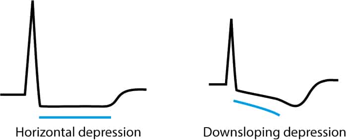 Figure 1. Caractéristiques des dépressions ischémiques du segment ST sur l’ECG.