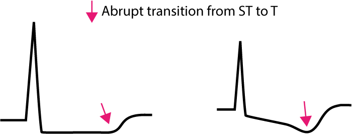 Figure 2. Transition entre le segment ST et l’onde T en cas d’ischémie.