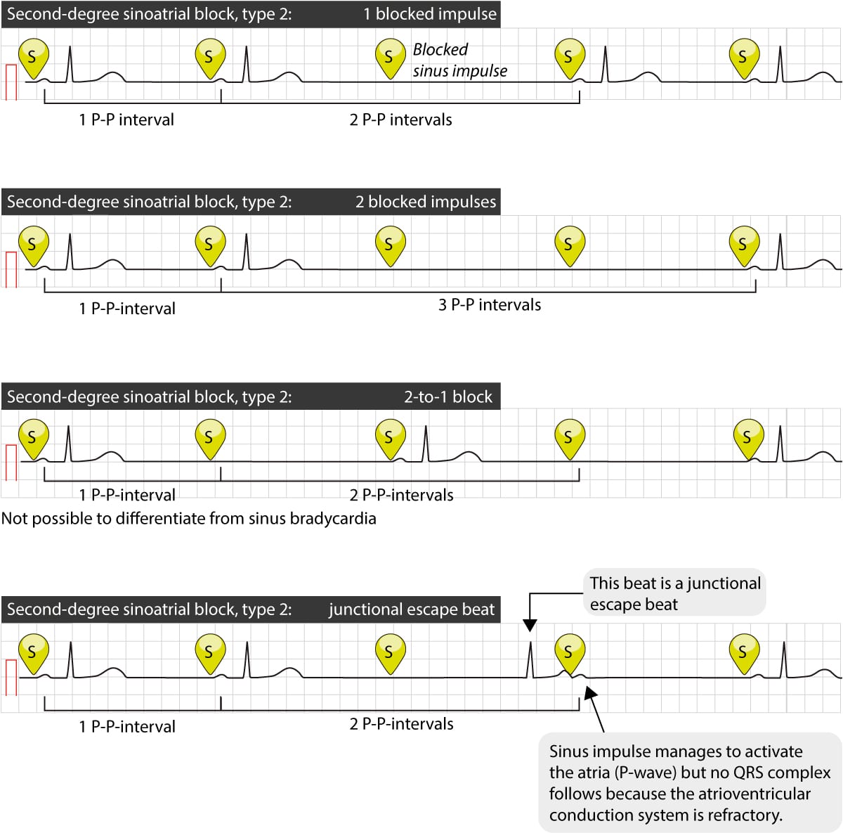 Figure 3. Plusieurs cas de bloc sino-auriculaire du deuxième degré de type 2.