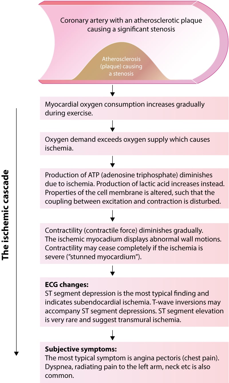 Figure 2. La cascade ischémique illustre l'évolution de l'ischémie vers les modifications de l'ECG et les symptômes cliniques. Comme illustré, les symptômes cliniques (par exemple la douleur thoracique) sont les derniers événements d'un épisode ischémique. Il s'ensuit qu'une ischémie myocardique peut être présente même en l'absence de symptômes cliniques. De plus, l'ECG détecte davantage d'épisodes ischémiques que le patient n'en signale.