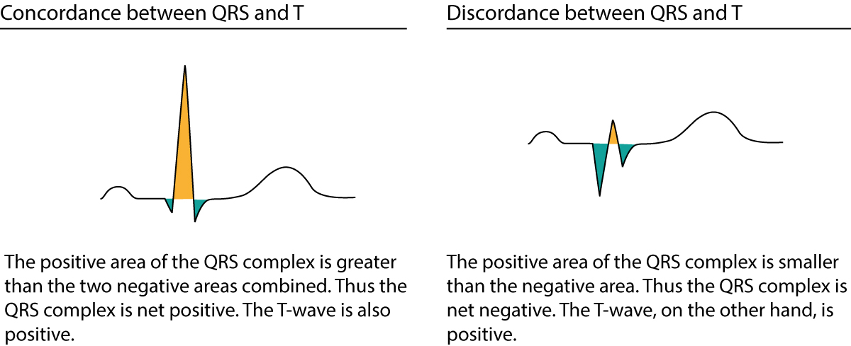 Figure 17. Discordance et concordance entre le QRS et le ST-T.